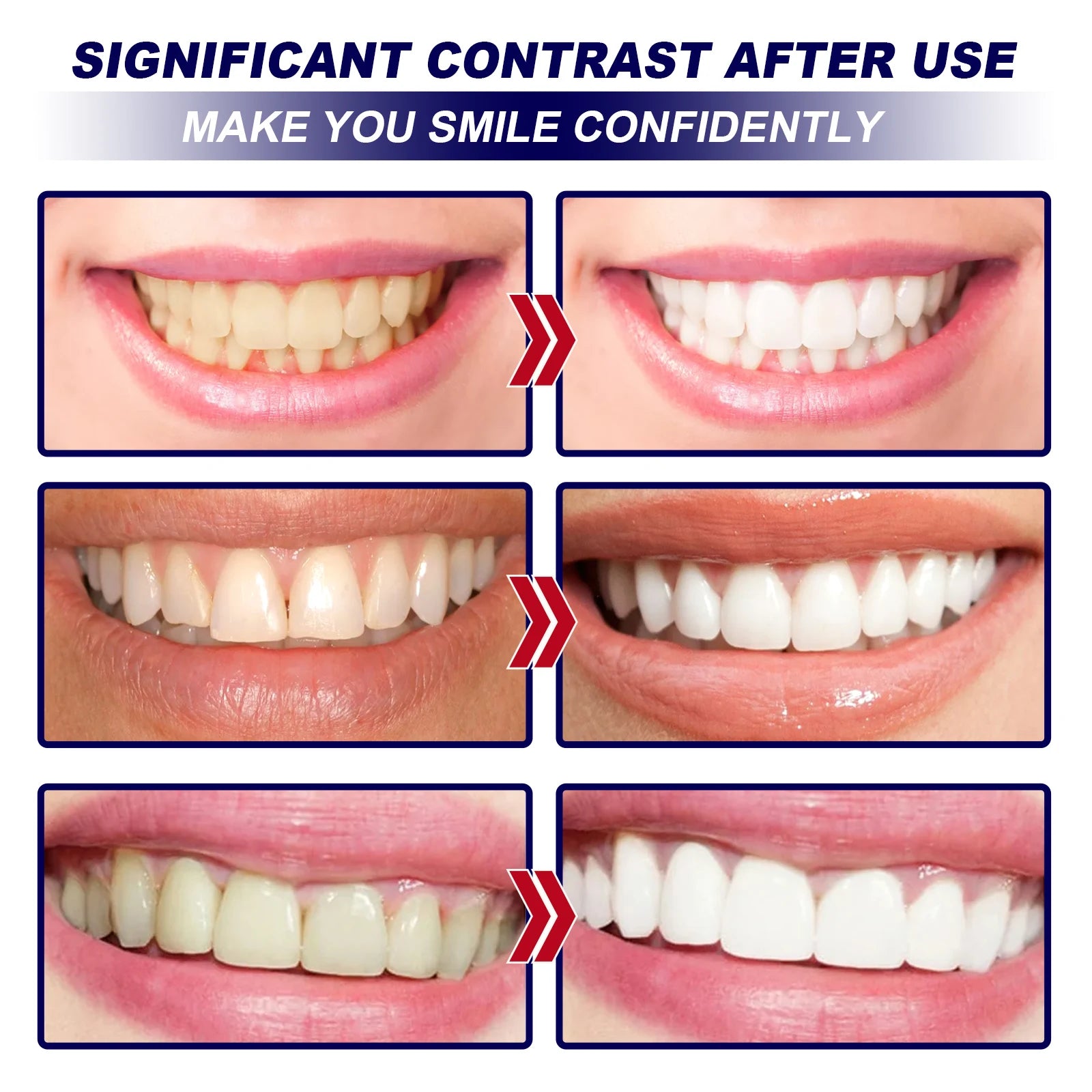 Before and after comparison of teeth whitening with significant contrast.