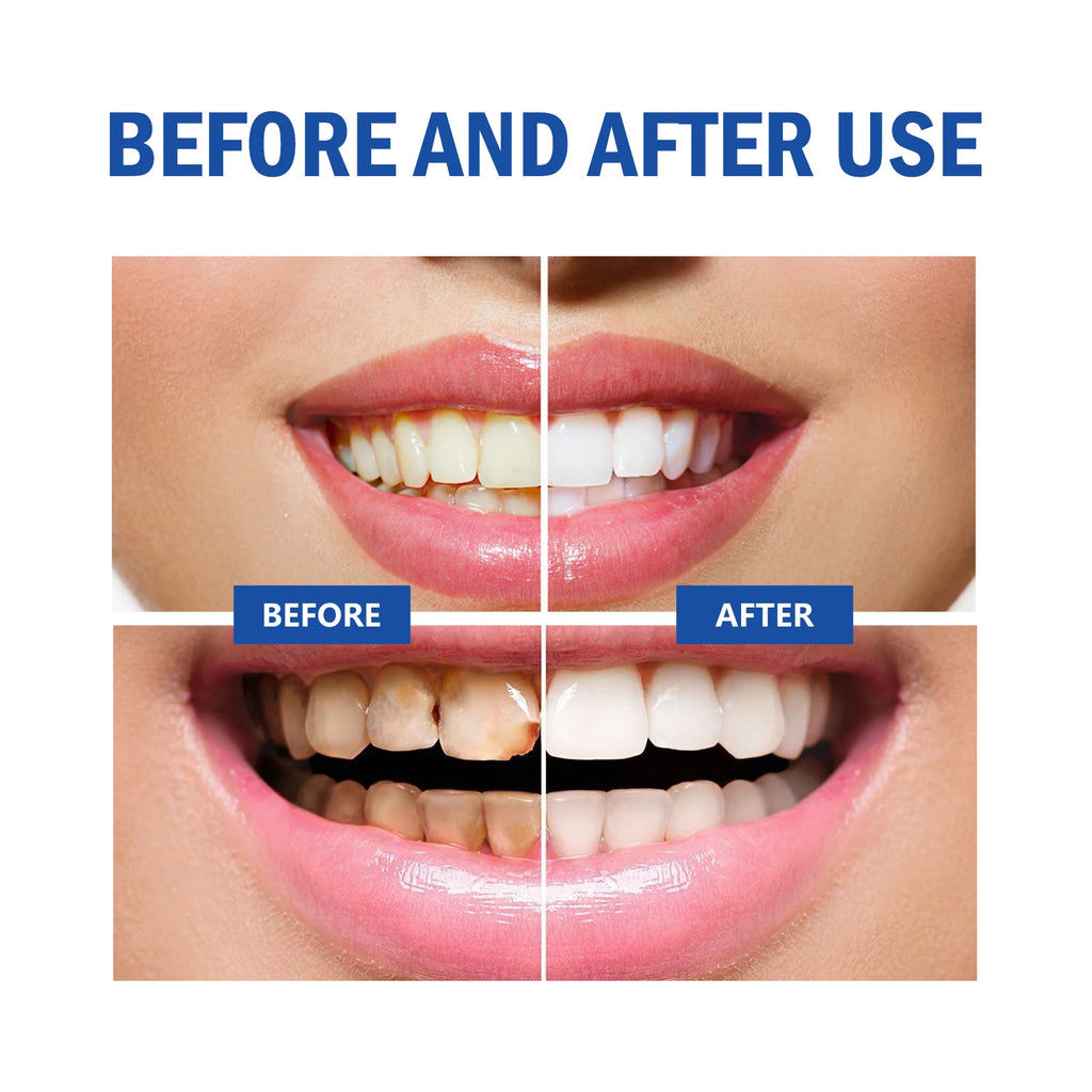 Before and after use comparison of teeth whitening with a blue 'BEFORE AND AFTER USE' label.